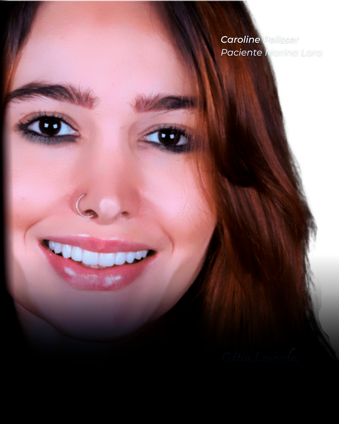 lentes-de-contato-dentais-dr-marina-lara-03
